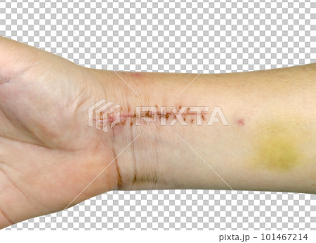 closeup stitches from broken arm surgery and bruised isolated 101467214