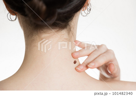 Dermatology. Close-up of a woman's neck. The hand shows a large mole. The concept of checking moles for malignancy Dermatology. Close-up of a woman's neck. The hand shows a large mole. The concept of checking moles for malignancy 101482340