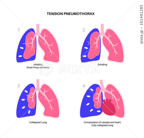 Tension pneumothorax poster 101491285