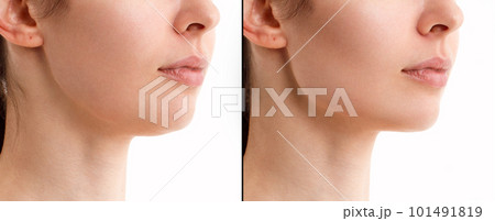 A close portrait of a woman before and after the facial rejuvenation procedure. Correction of the chin shape liposuction of the neck. Fillers in the cheekbones and chin. The result of the procedure in 101491819
