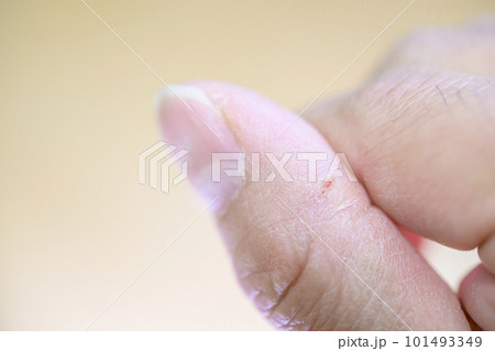 指先にできたあかぎれ 指先にできたあかぎれ 101493349