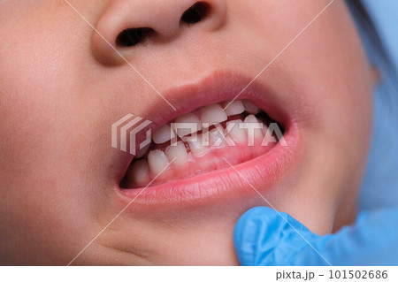 Close-up inside the oral cavity of a healthy child with beautiful rows of baby teeth. Young girl opens mouth revealing upper and lower teeth, hard palate, soft palate, dental and oral health checkup. 101502686