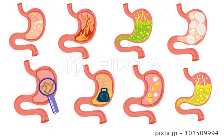Stomach diseases set. Bloating stomach ache, digestive tract pain fullness heaviness stomach, acid heartburn process indigestion duodenum reflux. Empty and full stomach. Vector illustration 101509994