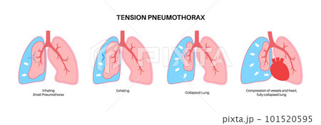 Tension pneumothorax poster 101520595