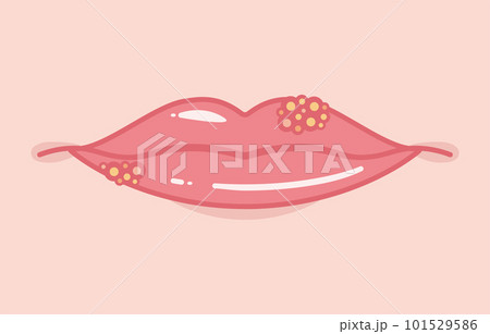 正面から見た口唇ヘルペスのイラスト 正面から見た口唇ヘルペスのイラスト 101529586