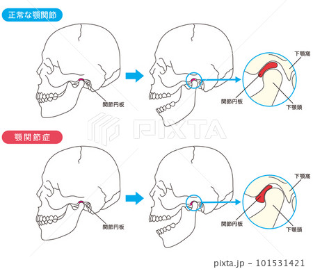 正常な顎関節と顎関節症の比較 101531421