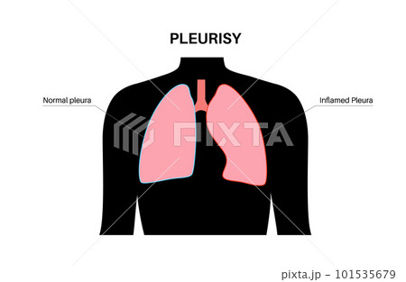 Pleurisy inflammation diseases Pleurisy inflammation diseases 101535679
