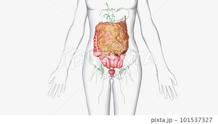 Stage III ovarian cancer has spread beyond the pelvis area to the abdomen. 101537327
