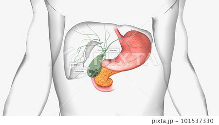 Gallstones are pieces of solid material that form in the gallbladder, a small hollow organ located beneath the liver. 101537330