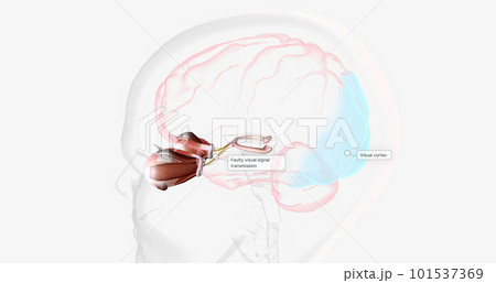 Strabismic Amblyopia, Visual Pathway with Eye Movement 101537369