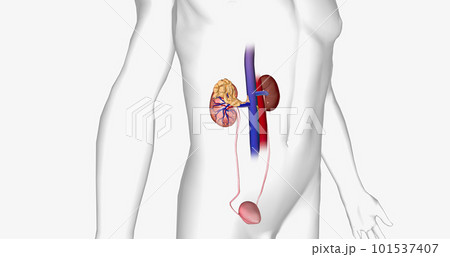 The Kidney Cancer, Stage IV The Kidney Cancer, Stage IV 101537407