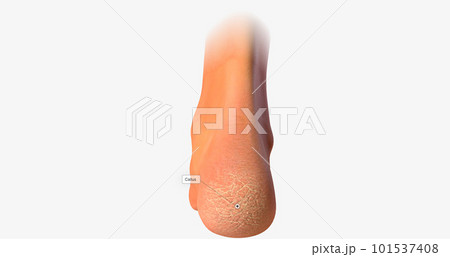 A callus is an area of thickened, hardened skin that develops as a result of frequent rubbing or repetitive motion. A callus is an area of thickened, hardened skin that develops as a result of frequent rubbing or repetitive motion. 101537408