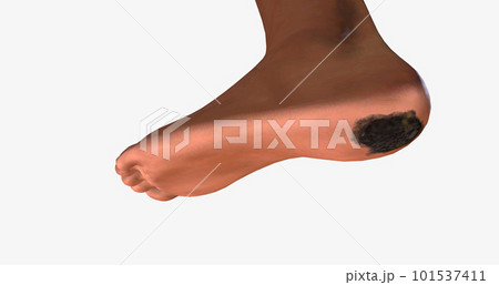 Acral Lentiginous Melanoma (ALM) on The Body Acral Lentiginous Melanoma (ALM) on The Body 101537411