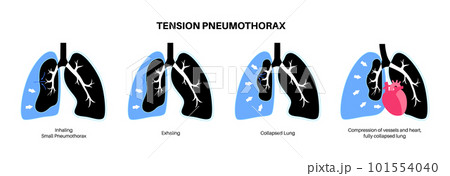Tension pneumothorax poster 101554040