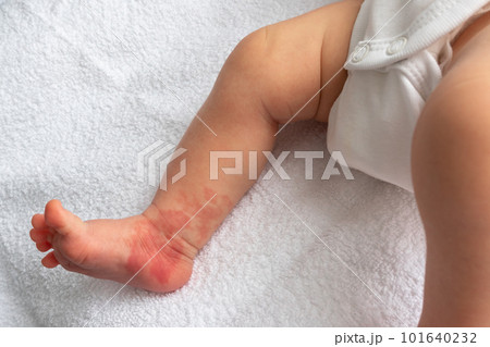 Hemangioma red birthmark on the leg of newborn baby Hemangioma red birthmark on the leg of newborn baby 101640232