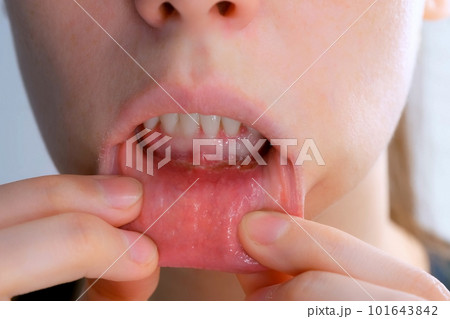 Stomatitis in woman's mouth after dental treatment, disease in the mouth. 101643842