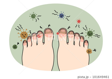 Unhealthy foot with nail infection or virus Unhealthy foot with nail infection or virus 101649461