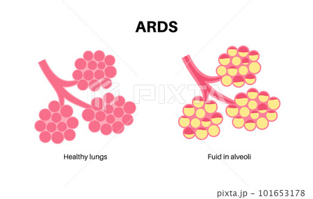 ARDS anatomical poster 101653178