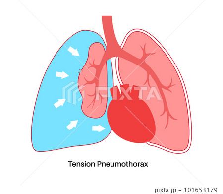Tension pneumothorax poster 101653179