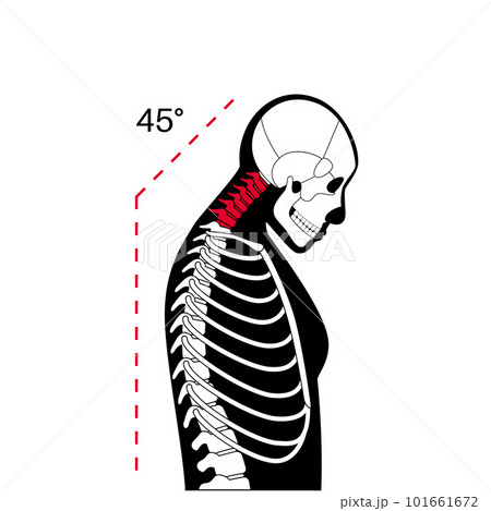Neck vertebrae deformity 101661672