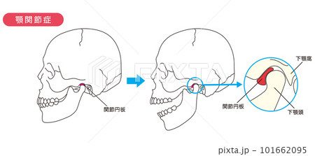 顎関節症の説明図 顎関節症の説明図 101662095