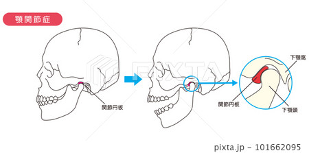 顎関節症の説明図 101662095