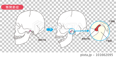 Illustration of temporomandibular disorder 101662095