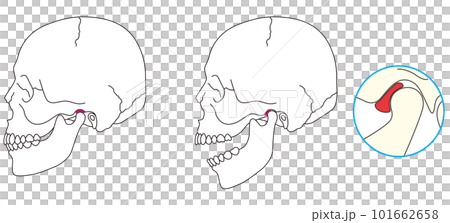 Illustration of temporomandibular disorder Illustration of temporomandibular disorder 101662658