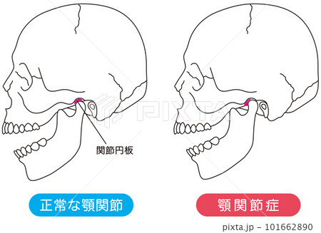 正常な顎関節と顎関節症の比較 正常な顎関節と顎関節症の比較 101662890