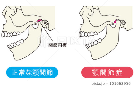 正常な顎関節と顎関節症の比較 101662956
