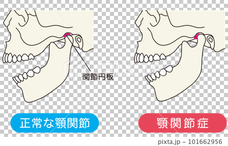 正常な顎関節と顎関節症の比較 101662956
