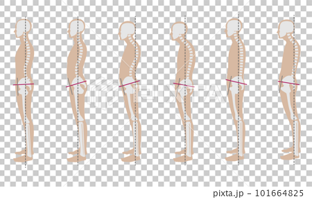 Male Skeleton Sample With Good And Bad Posture Stock Illustration -  Download Image Now - Bad Posture, Bone, Kyphosis - iStock