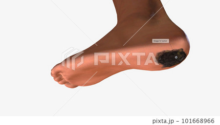 Acral Lentiginous Melanoma (ALM) on The Body 101668966