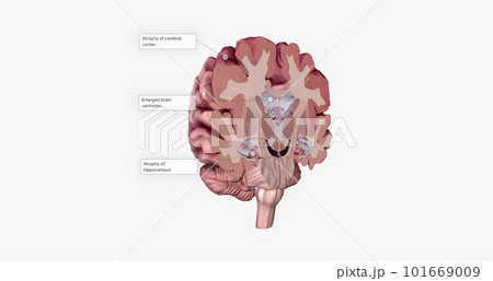 Alzheimer's Disease Brain Cross Section Alzheimer's Disease Brain Cross Section 101669009
