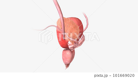 The Bladder Cancer, Stage III 101669020