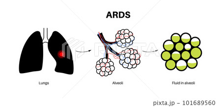 ARDS anatomical posterのイラスト素材 [101689560] - PIXTA