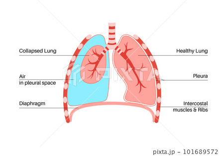 Pneumothorax anatomical poster 101689572
