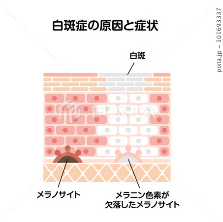 白斑(はくはん)の原因と症状イラスト (皮膚断面図図解) 白斑(はくはん)の原因と症状イラスト (皮膚断面図図解) 101693337