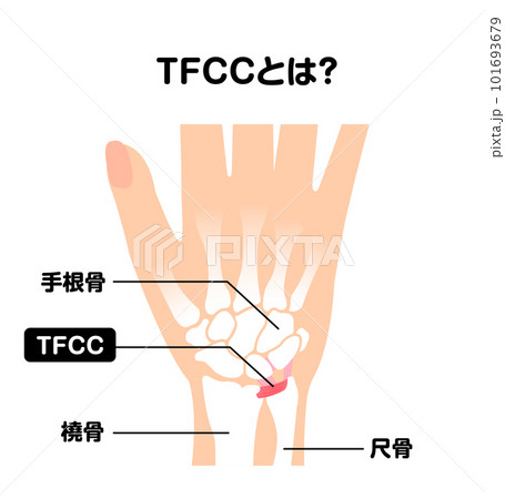 TFCC (三角線維軟骨複合体) とは? 図解ベクターイラスト TFCC (三角線維軟骨複合体) とは? 図解ベクターイラスト 101693679