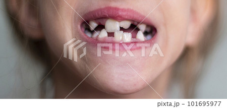 Wrong bite in a child. Problem of teeth in children 101695977