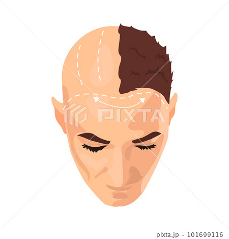 Hair transplantation illustration in color cartoon style. Editable vector graphic design. Hair transplantation illustration in color cartoon style. Editable vector graphic design. 101699116