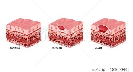 Peptic ulcer stages development illustrationのイラスト素材 [101699400] - PIXTA