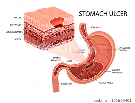 Peptic ulcer in stomach infographic Peptic ulcer in stomach infographic 101699401