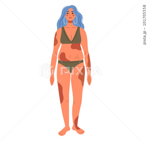 Woman with melasma, dark brown pigment spots on body. Dermatology, cosmetology concept. Skin cancer concept. Inclusion and body-positivity concept. Flat Vector Illustration Woman with melasma, dark brown pigment spots on body. Dermatology, cosmetology concept. Skin cancer concept. Inclusion and body-positivity concept. Flat Vector Illustration 101705558