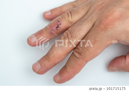 Stitched wound on a finger. Hand with stitched cut wound 101715175