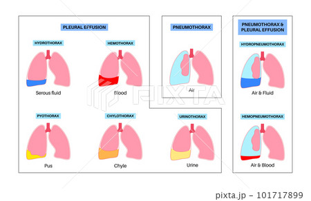 Pleural effusion poster 101717899