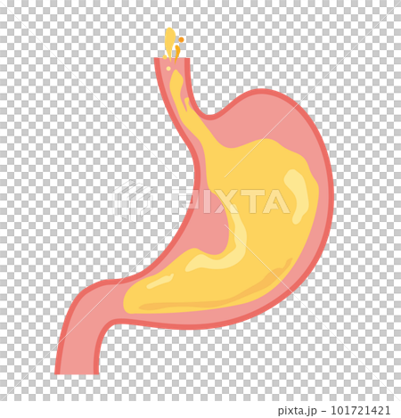 反流性食管炎的形像說明 101721421