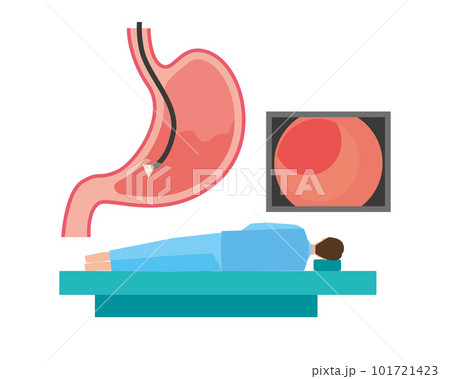 胃カメラでの検査のイメージイラスト 胃カメラでの検査のイメージイラスト 101721423