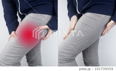 Before and after. On left, a woman has acute pain in the hip after a muscle strain or tear. On right, doctors have healed and the muscles of the thigh are no longer disturbed. Bone fracture 101739359