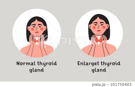 Normal and enlarget thyroid gland. Woman showing thyroid gland on her neck. Endocrinology system symbol, organ responsible for hormone production. Flat vector isolated illustration 101750403